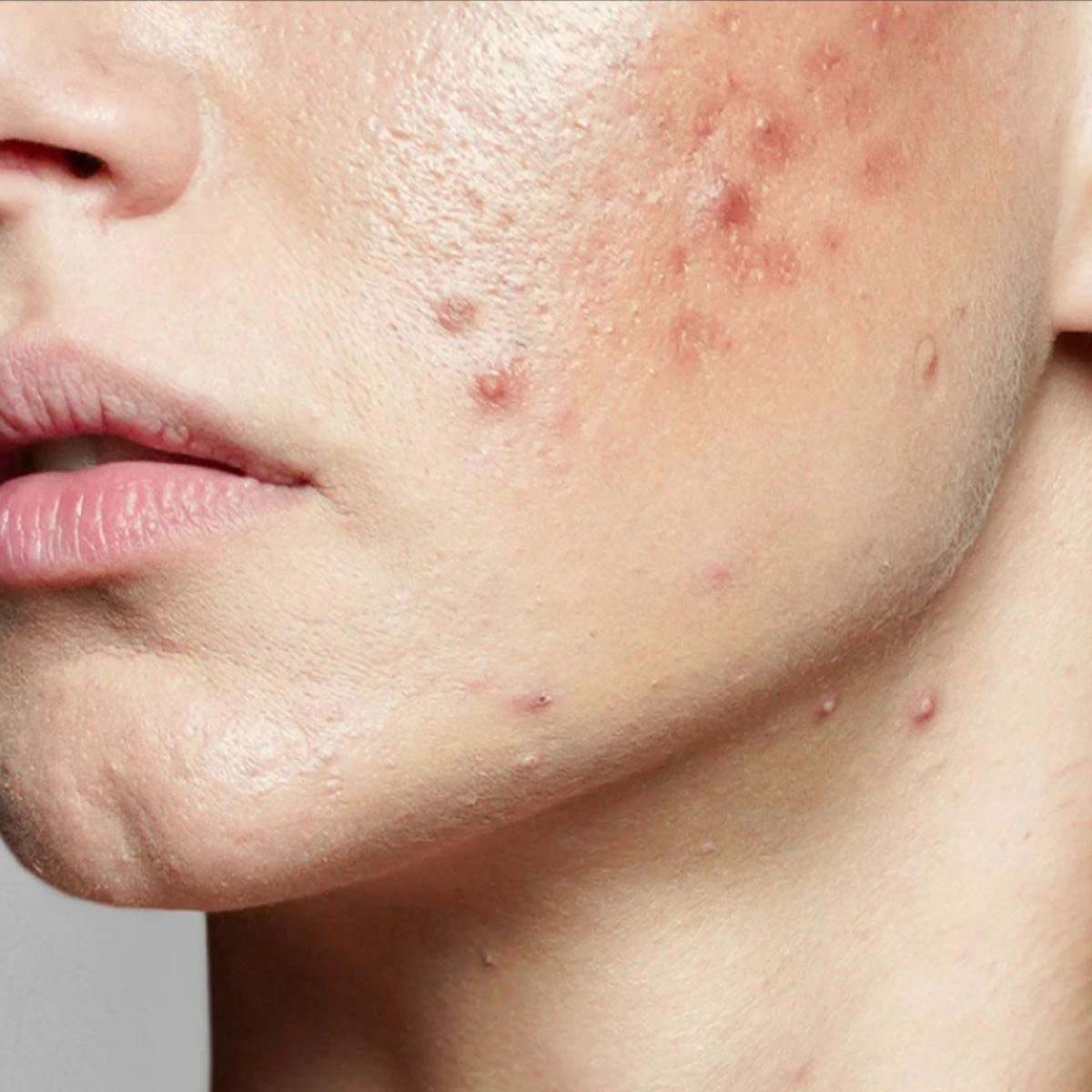 Common Acne Signs