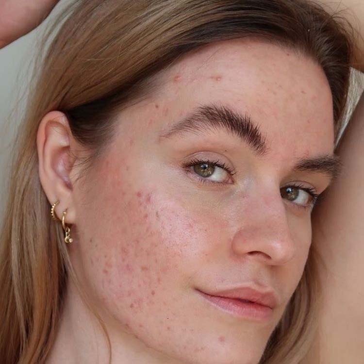 Common Acne Signs