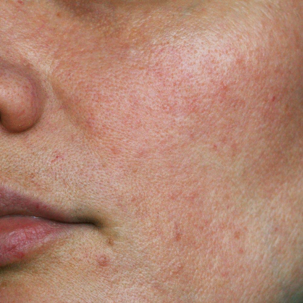 Compromised Skin Barrier