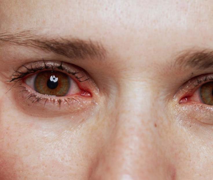 Allergic Reaction to False Lashes